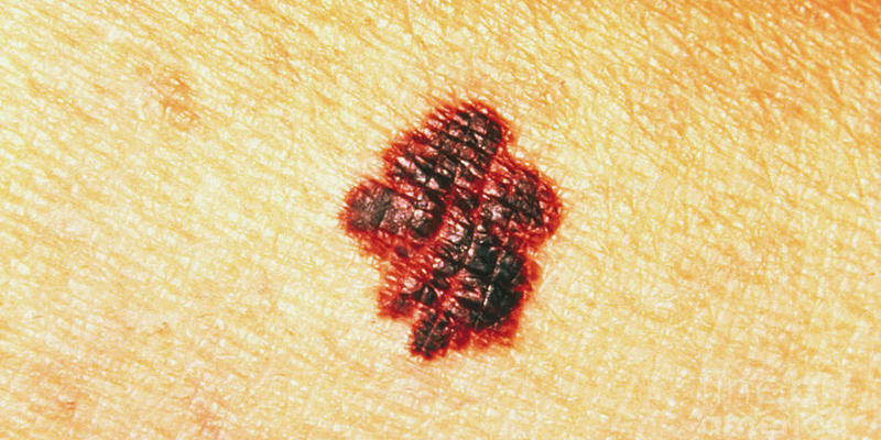 Gambar Tahi Lalat yang Berbahaya - Pinggiran