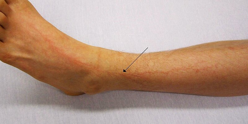 apa dampak jika tersambar petir